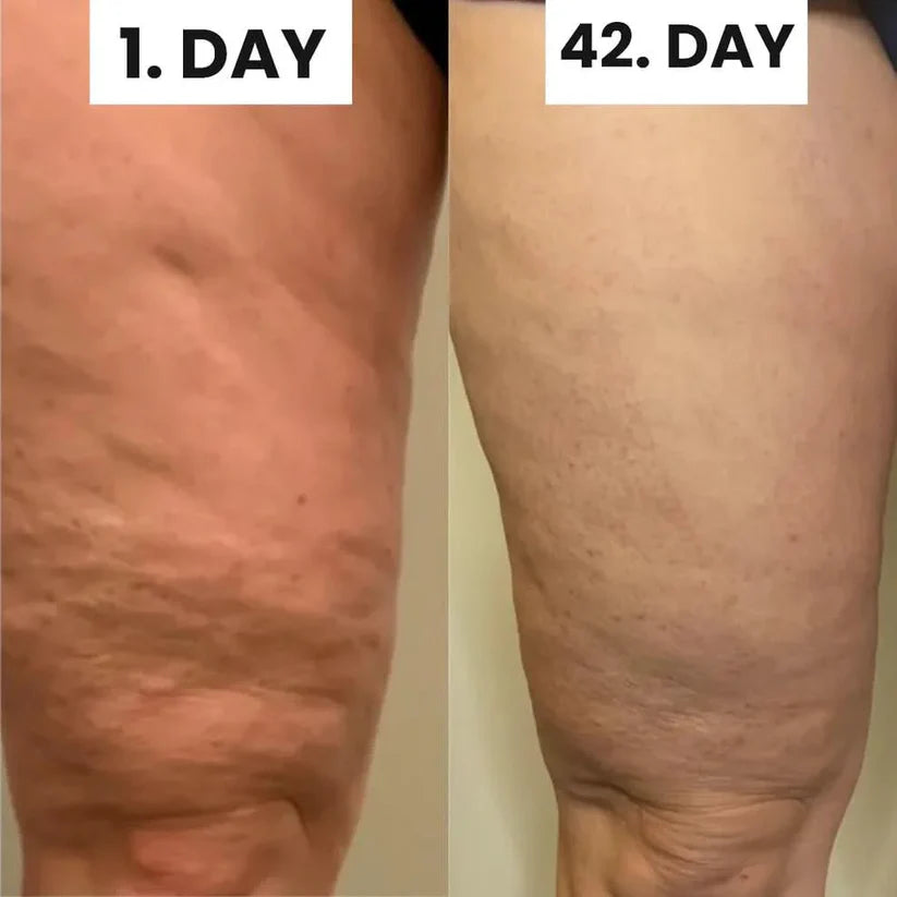 Velvace™ Cellulite Relief Kit